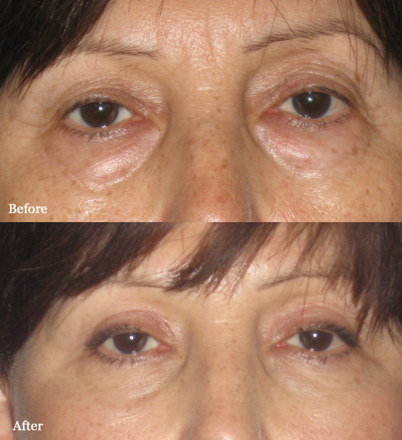 Visage San Francisco Plastic Surgery Office Eyelid Lift Before and After