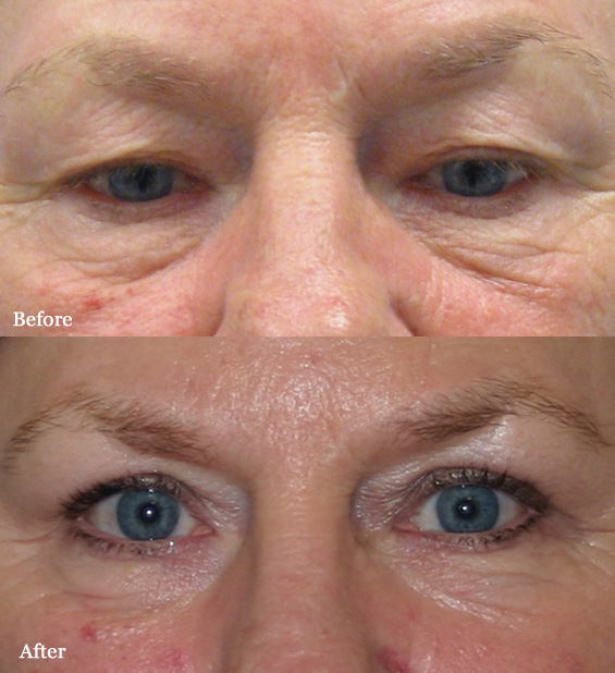 Visage San Francisco Plastic Surgery Office Eyelid Lift Before and After
