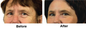 Laser EyeLid Lift Before and After