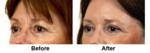 Laser EyeLid Lift Before and After