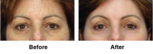 Laser EyeLid Lift Before and After