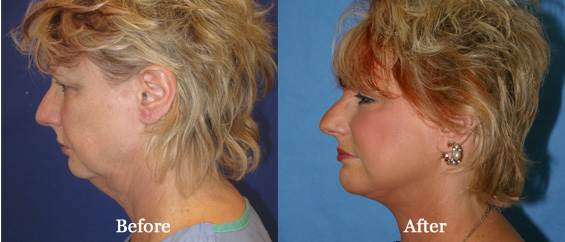 Visage San Francisco Plastic Surgery Office Facelift Before and After