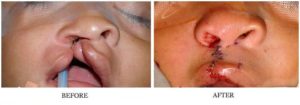 Cleft Palate Surgery Before and After