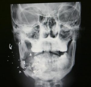 Facial Trauma Surgery