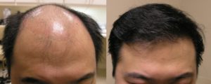 Visage San Francisco Plastic Surgery Hair Restoration Before and After