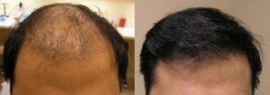 Visage San Francisco Plastic Surgery Hair Restoration Before and After
