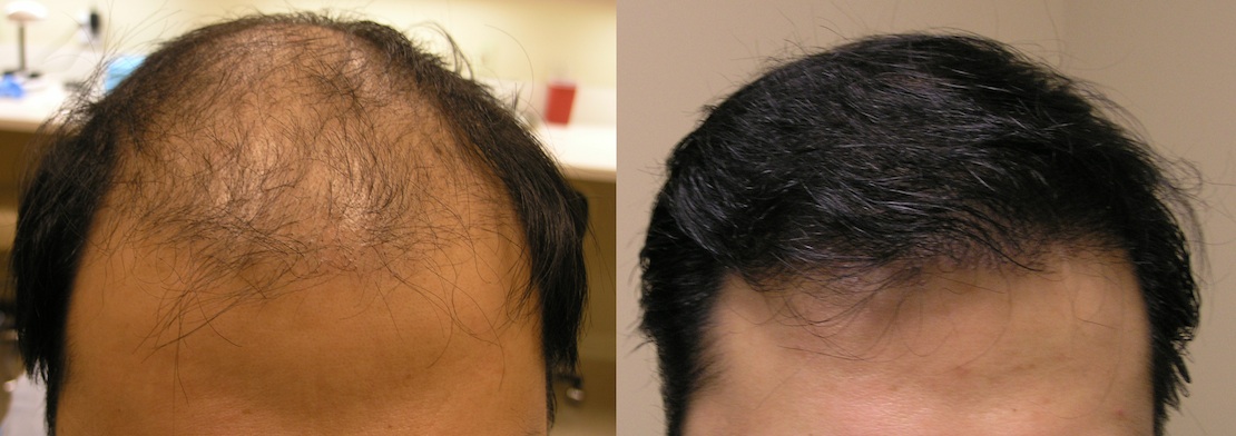 San Francisco Hair Transplant and Hair Restoration | Visage, San Francisco  Plastic Surgery