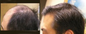 Visage San Francisco Plastic Surgery Hair Restoration Before and After