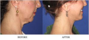 Necklift Before and After