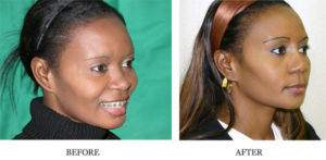 Nose Reshaping - Female