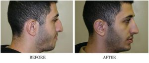 Nose Reshaping - Male