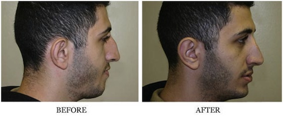 Visage San Francisco Plastic Surgery Office Nose Reshaping Before and After