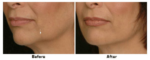 Jaw injections using a Filler for Facial Rejuvenation