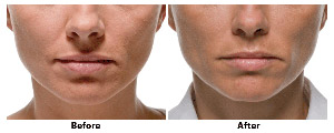 Lip injections using a Filler for Facial Rejuvenation